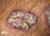 Lupus Erythematosus Chronicus Verrucous. Adapted from Dermatology Atlas.[26]