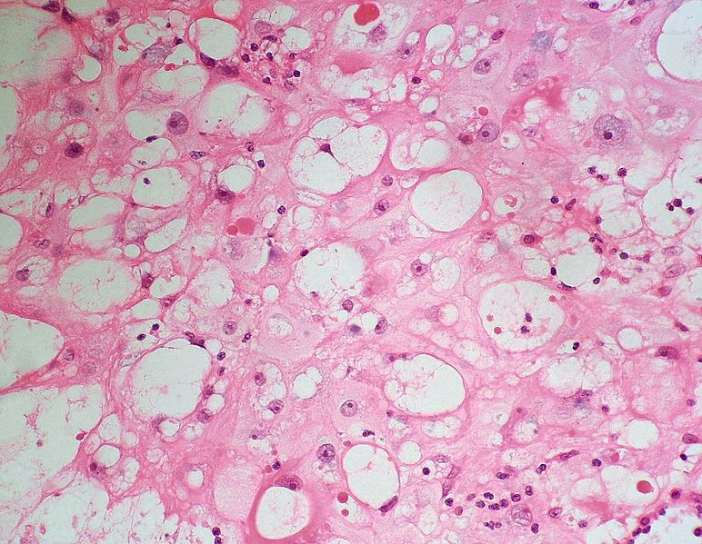 File:Physaliferous cells.jpg