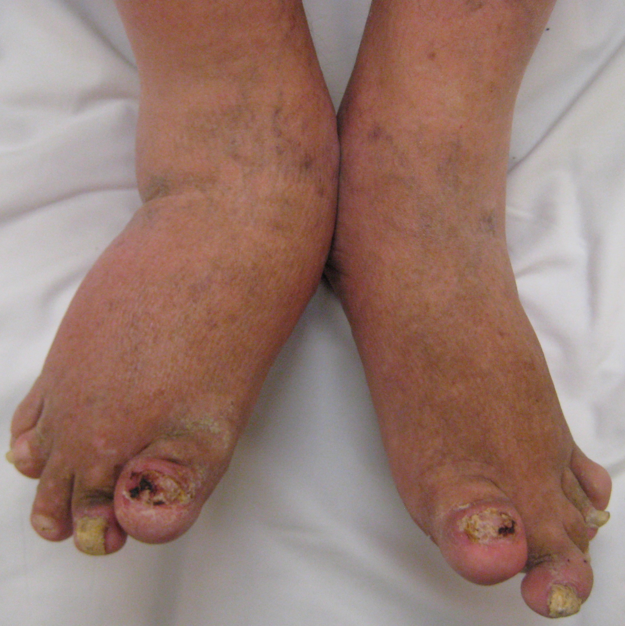 File:Psoriatic arthritis of feet.jpg