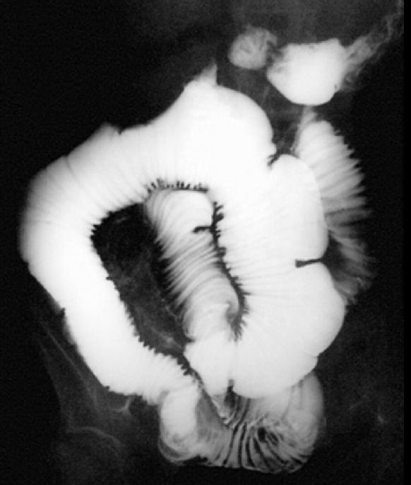 Barium graphy: Small intestine and colon involvements. (Image courtesy of RadsWiki and copylefted)