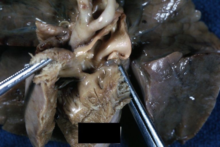 Subpulmonic Ventricular Septal Defect: Gross, a well shown lesion.