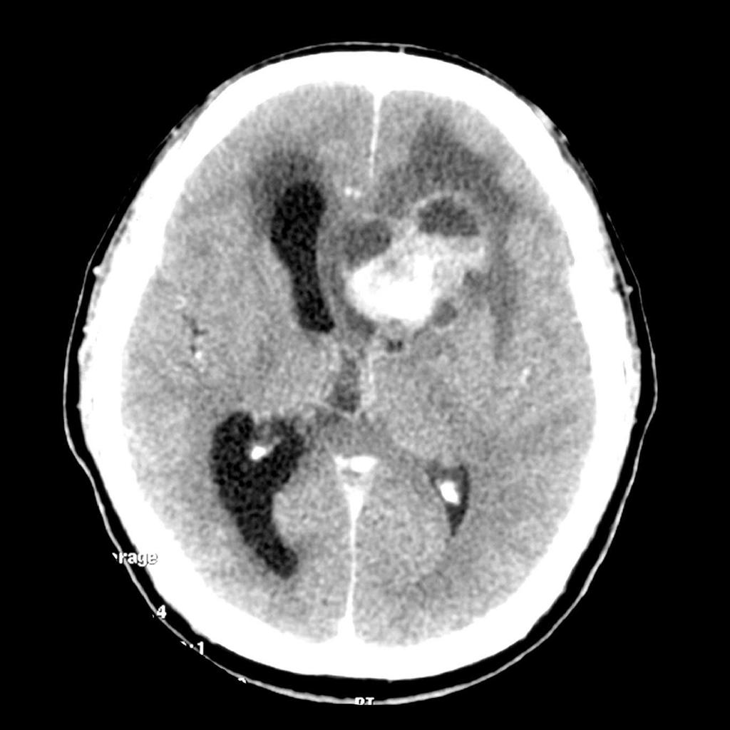 A large, heterogeneous mass is present within the left frontal lobe. It is strikingly hyperdense, without definite calcification. The solid component enhances. Hydrocephalus is present, best seen on the right, due to outflow obstruction (contrast CT)[2]