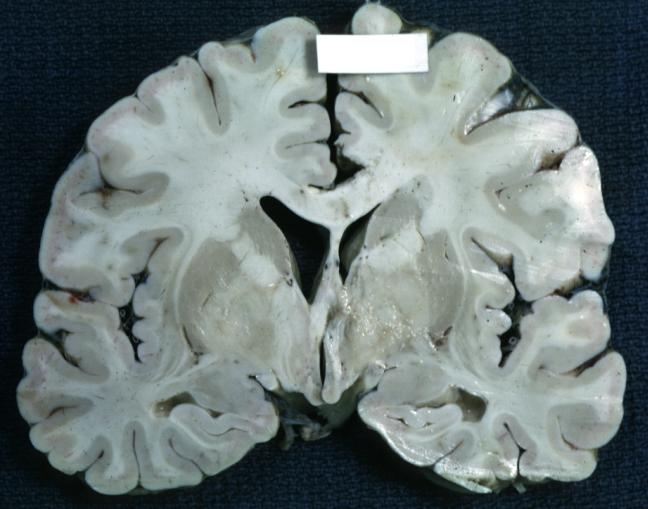 Brain: Cerebral Sarcoma or Microglioma: Gross; fixed tissue, coronal section, cerebral hemispheres