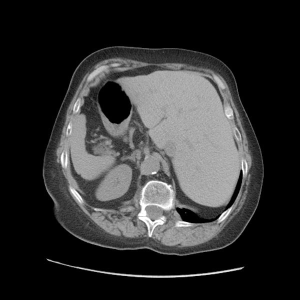 Situs inversus in a patient with Kartagener syndrome (Image courtesy of RadsWiki and copylefted)