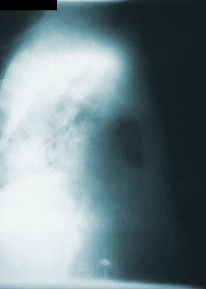 This right-lateral chest x-ray revealed evidence of a pulmonic infection 13 days after this patient had been exposed to the bacillus, Bacillus anthracis, the cause of the disease known as anthrax. Adapted from Public Health Image Library (PHIL), Centers for Disease Control and Prevention.[3]