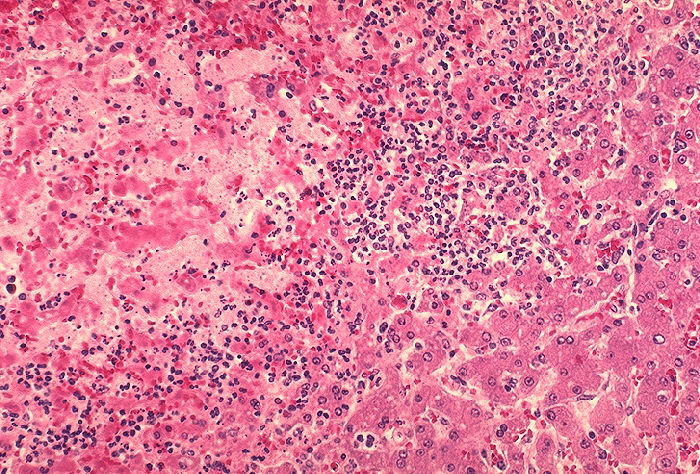 Histopathology of liver in fatal human plague. Focal hepatocellular necrosis adjacent to thrombosis. Adapted from Public Health Image Library (PHIL), Centers for Disease Control and Prevention.[18]