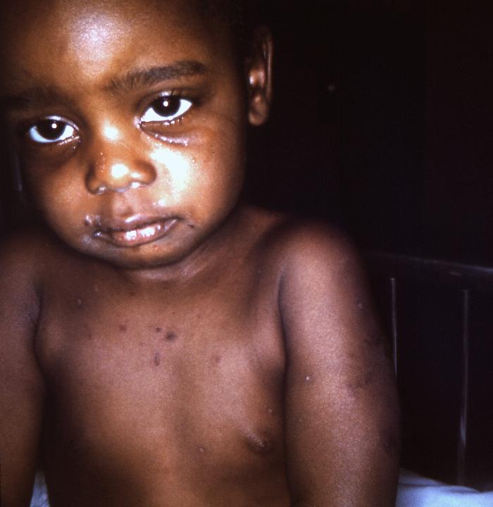 2 year-old Georgian female patient who after receiving a smallpox vaccination, developed an erythema multiforme reaction. Note maculopapular lesions on her chest, arms, and face. Adapted from Public Health Image Library (PHIL), Centers for Disease Control and Prevention.[14]