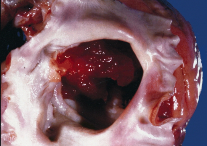 Image B Cardiac Myxoma A gelatinous tumor is attached by a narrow pedicle to the atrial septum. The myxoma has an irregular surface and nearly fills the left atrium.