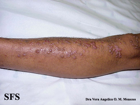 File:Epidermolysis bullosa pruriginosa13.jpg