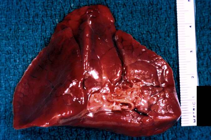 This is a gross photograph of lung demonstrating hyaline membrane disease (Infant respiratory distress syndrome) and atelectasis.