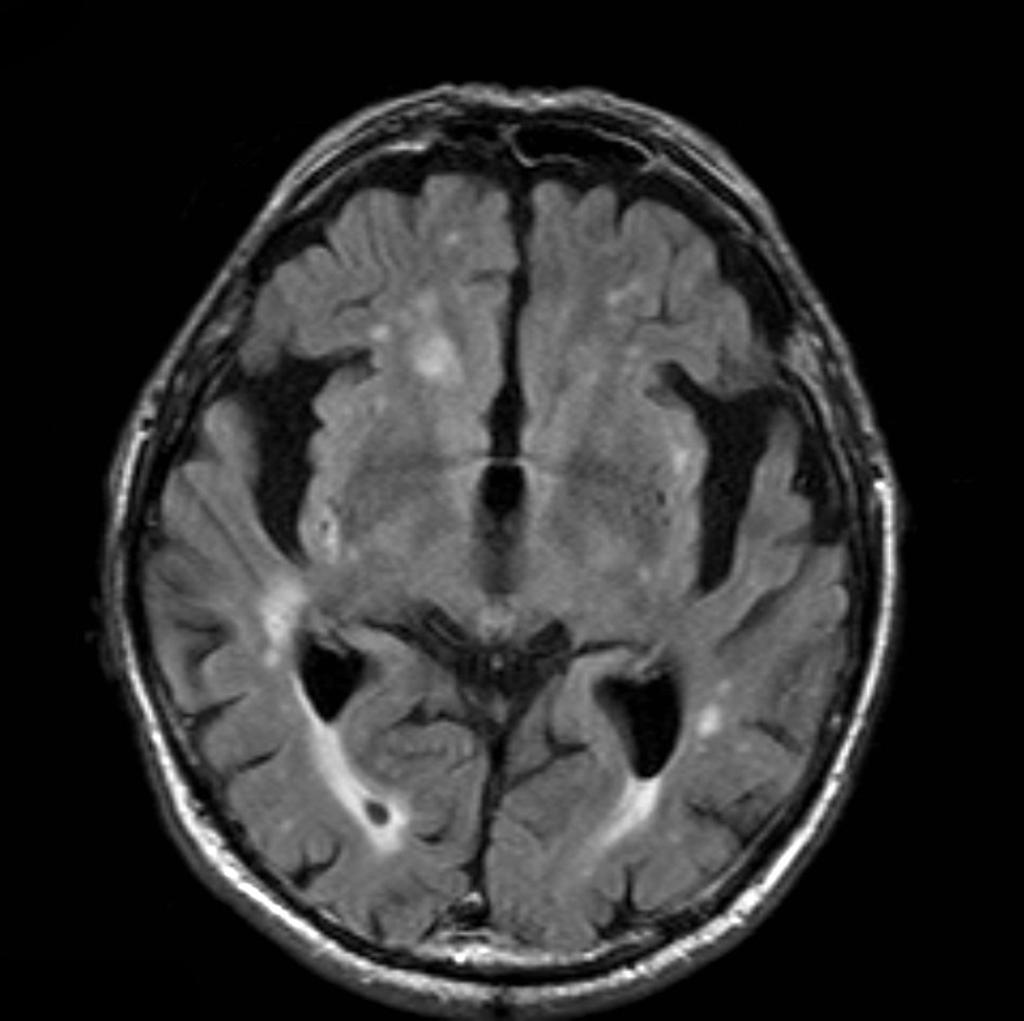 File:MRI - alzheimer-disease-FLAIR.jpg