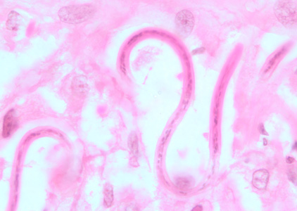 File:O volvulus filaria BAM3.jpg