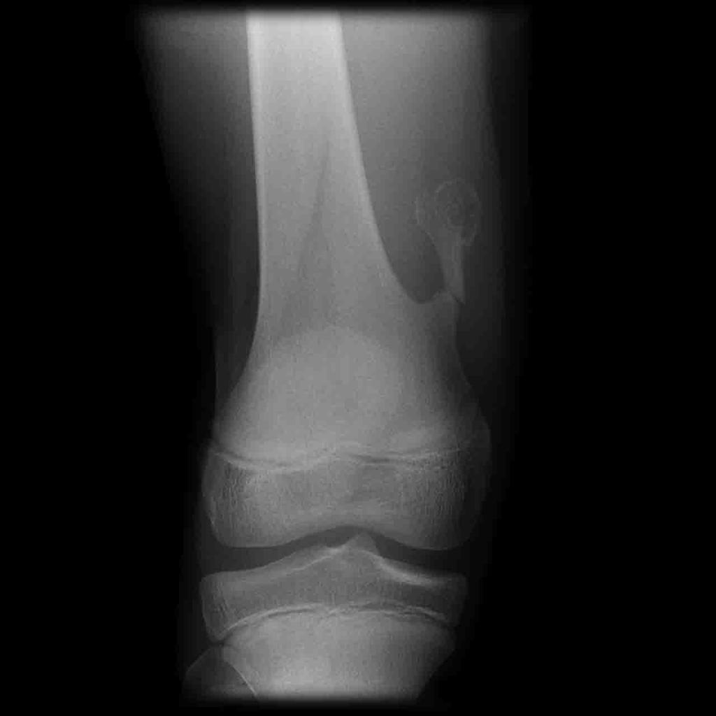 Conventional radiography: Image shows a fracture of a pedunculated osteochondroma.