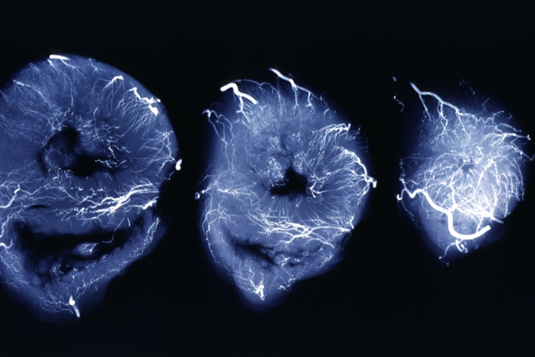 X-Ray Intramyocardial Arteries: X-ray three horizontal slices of ventricles showing quite well the penetrating arteries