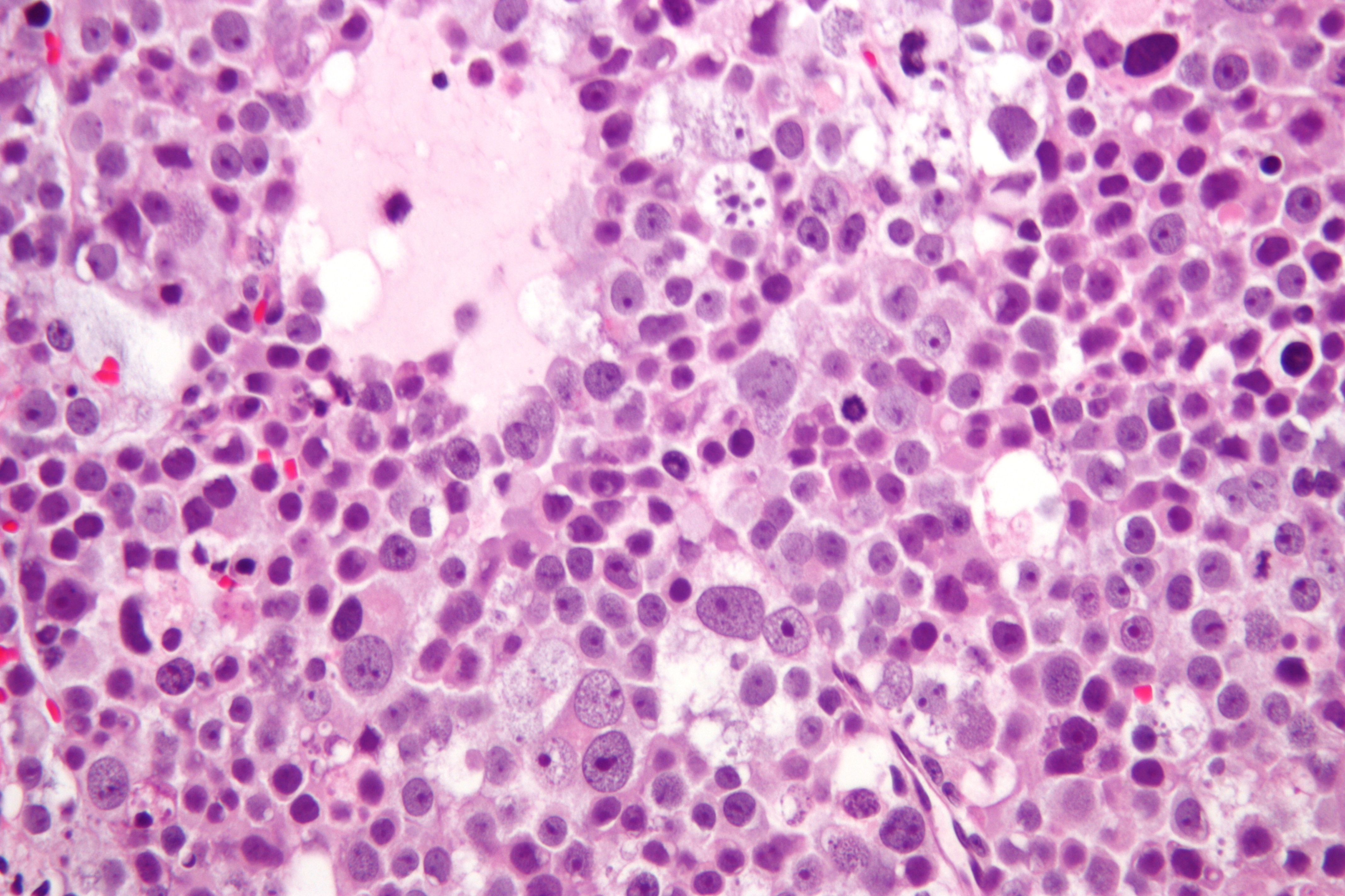 File:Spermatocytic seminoma high mag.jpg