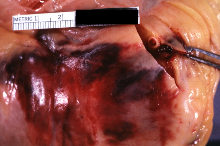 Atherosclerosis: Coronary artery: Atherosclerosis and thrombotic occlusion: Gross, (an excellent example) in situ on heart