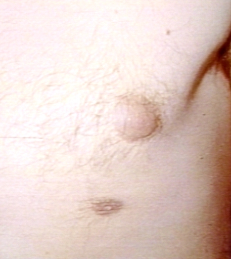 Breast: accessory nipple in a 23 years old male