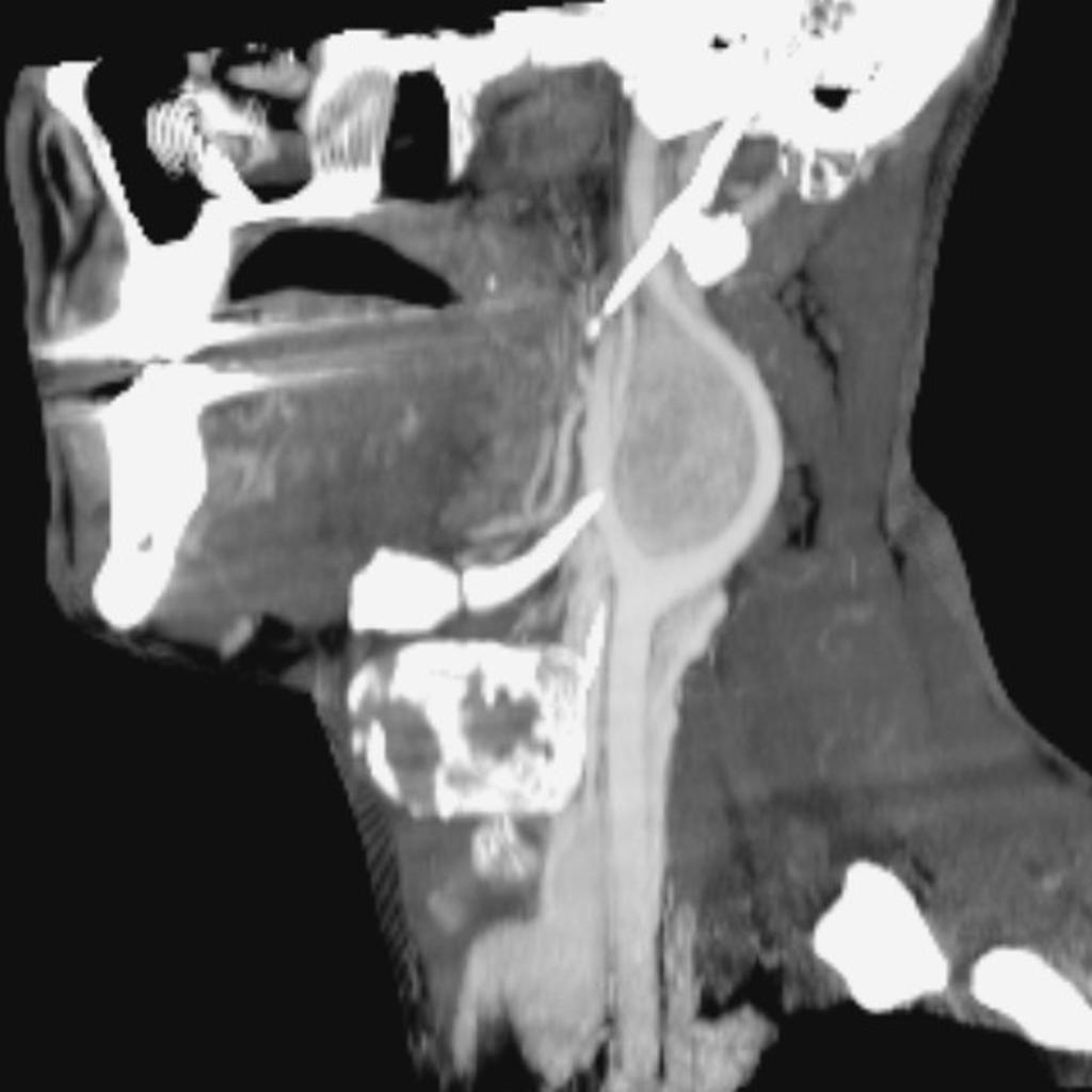 CT scan of carotid body tumor.[4]