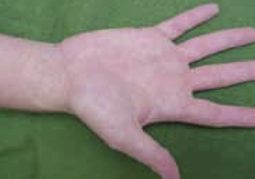 Maculopapular rash in extremities, including palms