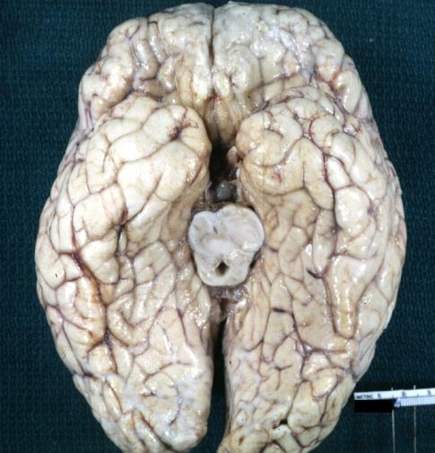 Brain: Pontine Glioma and Diffuse Meningeal Gliomatosis: Gross; fixed tissue, view of cerebral hemispheres from inferior with brain stem and cerebellum removed. Pontine asymmetry is easily seen due to low grade astrocytoma and meningeal gliomatosis is easily seen over frontal lobe