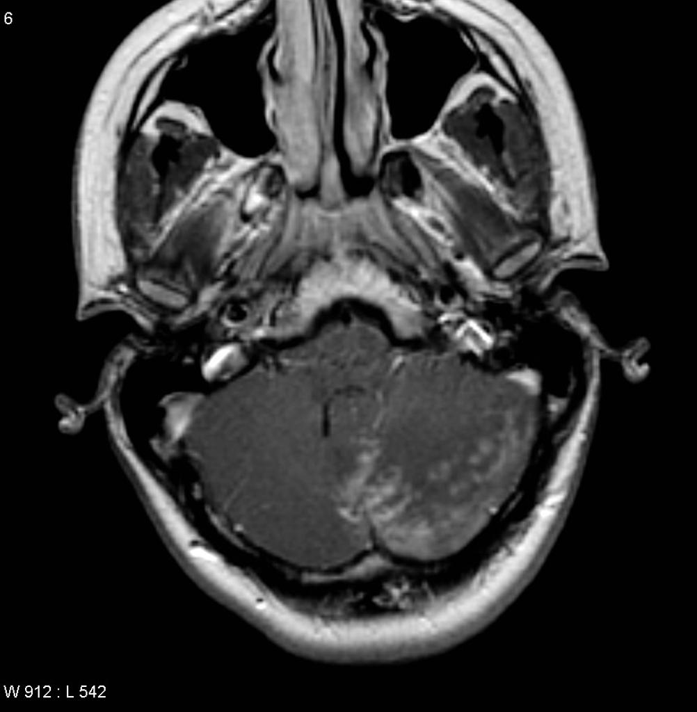 File:Neurosarcoidosis-and-chiari-i-malformation.jpg