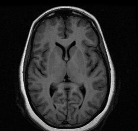 File:Normal-brain-MRI-004.jpg