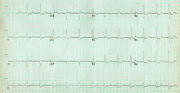File:Right bundle branch block 5.png
