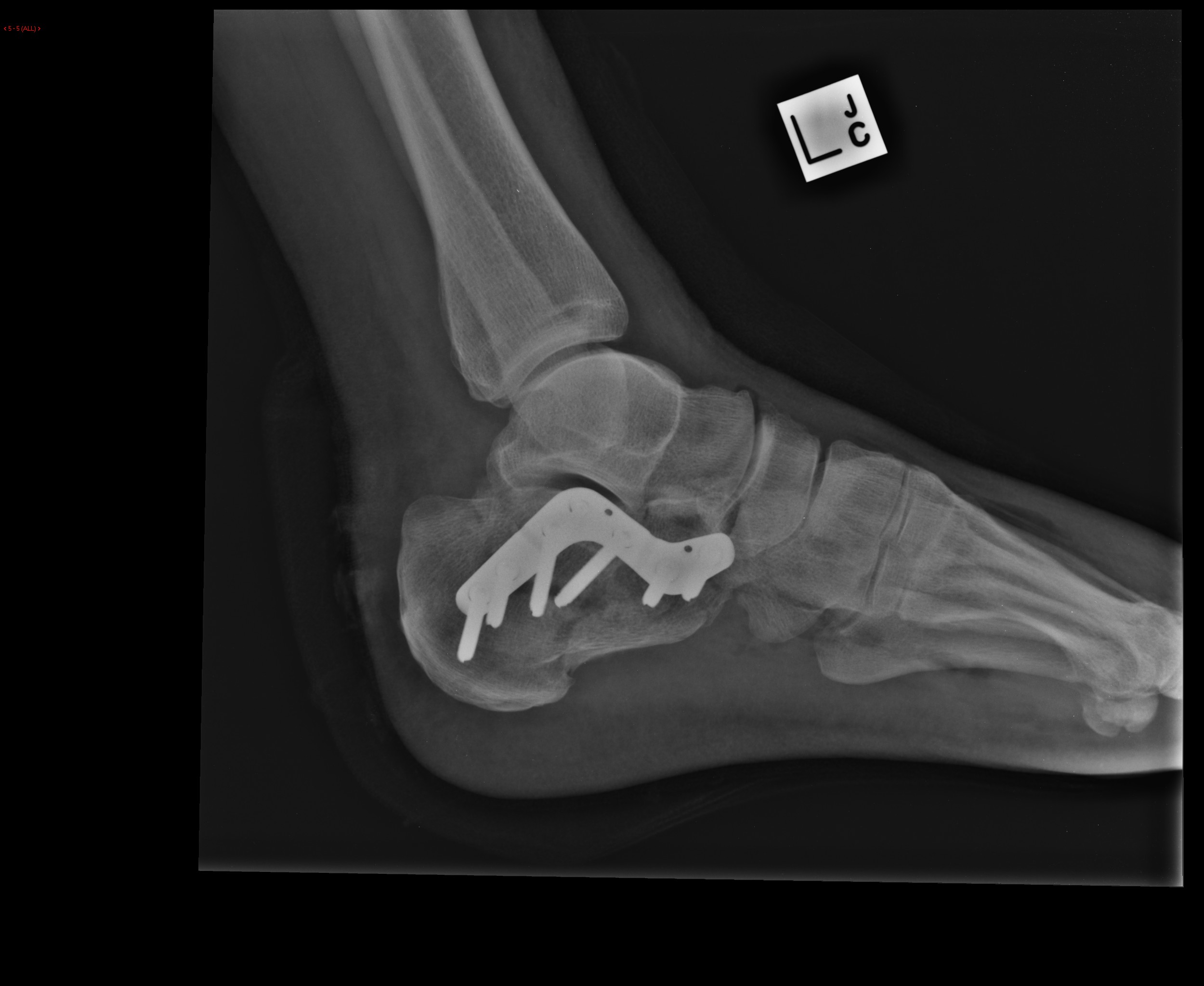 Post operation Calcaneal fracture