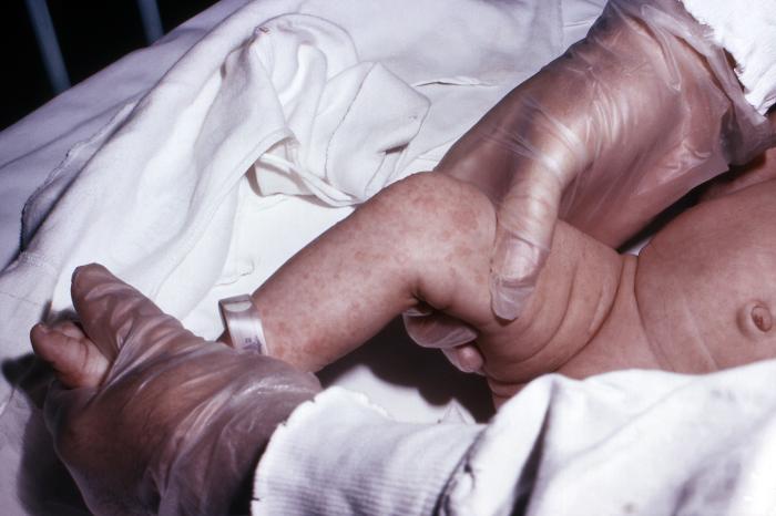 Right lower extremity of a 5 week-old male patient who after receiving a smallpox vaccination, developed an erythema multiforme reaction. Note how the maculopapular rash had spread to his right thigh and calfAdapted from Public Health Image Library (PHIL), Centers for Disease Control and Prevention.[3]