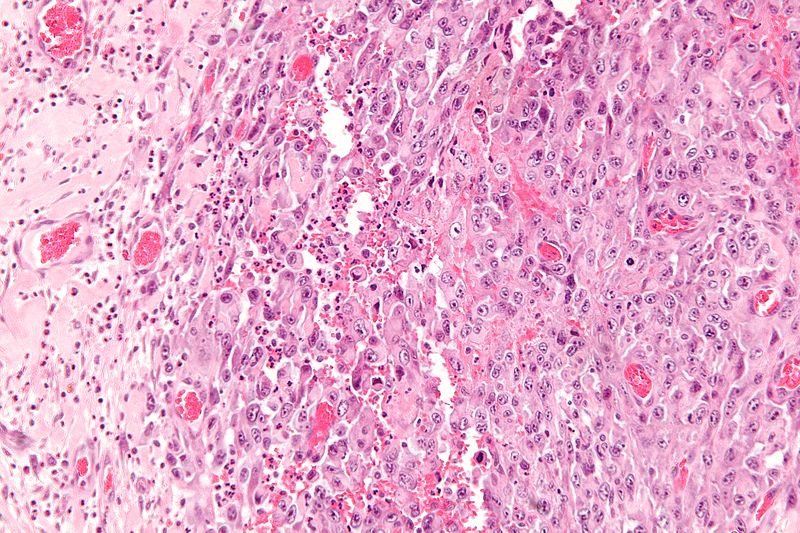 Low magnification micrograph of epithelioid sarcoma<ref> Epithelioid sarcoma librepathology