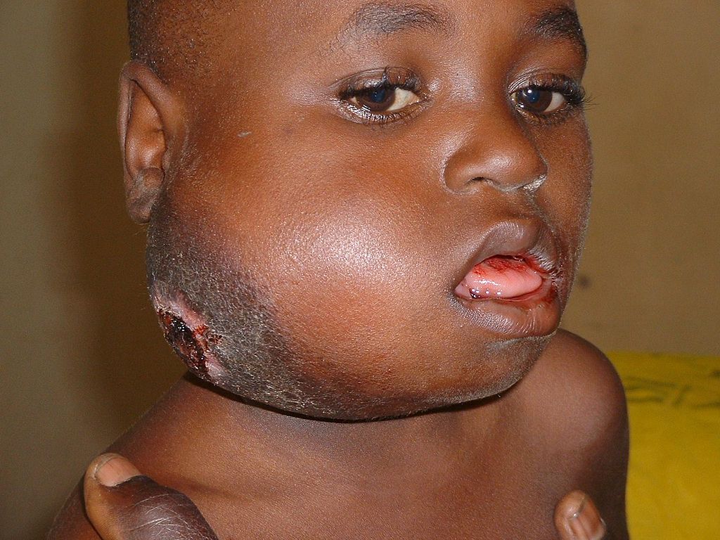 Seven-year-old Nigerian boy with a several-month history of jaw swelling which had been treated with antibiotics: The tumor was ulcerated and draining