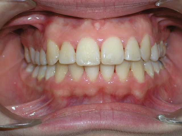After Orthodontic treatment (Frontal view)