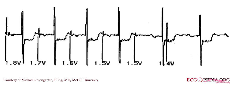 File:Pacemaker with atrial capture.jpg