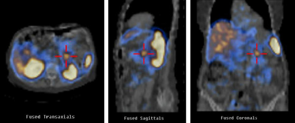 Somatostatin receptor scintigraphy with SPECT acquisition. Area of increased uptake anterior to the left kidney and medial to the spleen, consistent with the pancreatic mass[2]