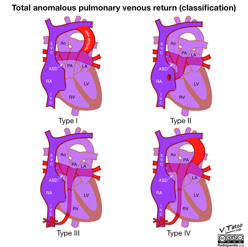 File:Total-anomalous-pulmonary-venous-return-illustration.png