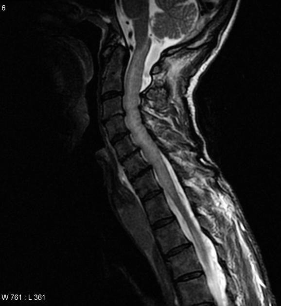Sagittal spinal T2 weighted MRI image illustrating heterogeneous and diffuse enhancement of chronic lymphocytic leukemia. [1]