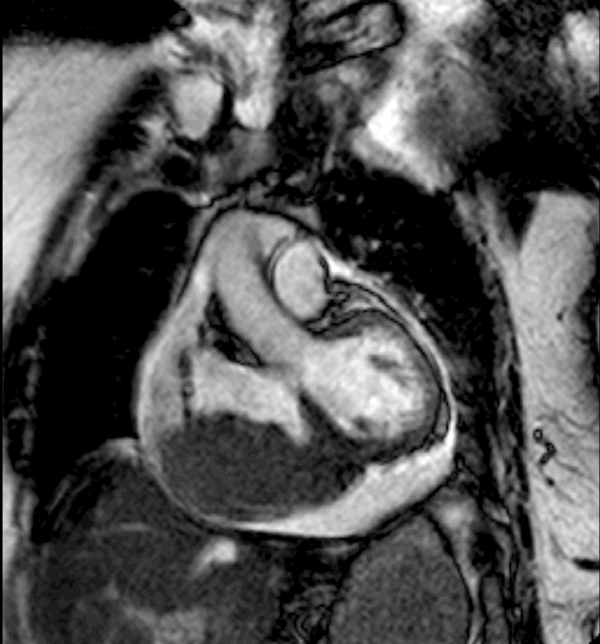 Cardiac MRI showing cardiac mass invading right atrial and right and left ventricular apical myocardium with compression of right atrial chamber