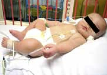 Infant with maculo-papular rash, petechial spots and erythema of upper and lower limbs associated with edema of the extremities