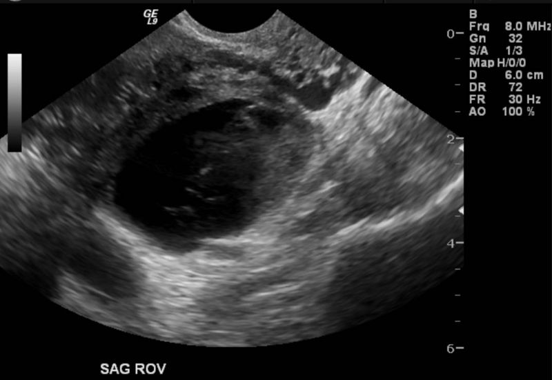 File:Hemorrhagic ovarian cyst 002.jpg