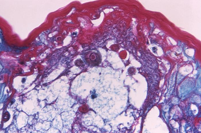 Hematoxylin-eosin (H&E)-stained photomicrograph reveals some of the cytoarchitectural histopathologic changes found in a human skin tissue specimen that included a varicella zoster virus lesion (500x mag). From Public Health Image Library (PHIL). [1]