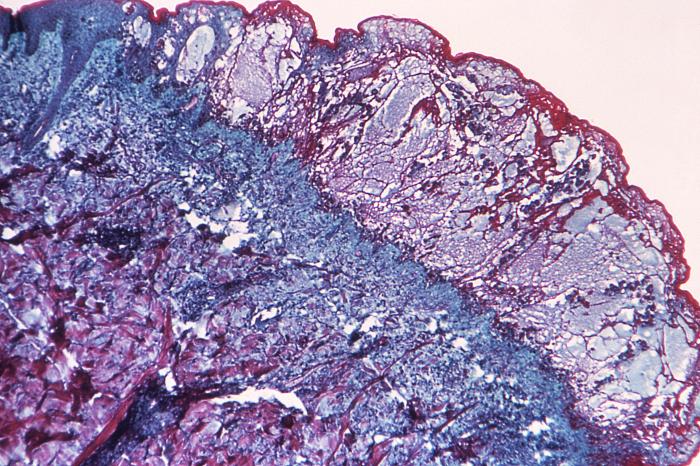 Hematoxylin-eosin (H&E)-stained photomicrograph reveals some of the cytoarchitectural histopathologic changes found in a human skin tissue specimen that included a varicella zoster virus lesion (50x mag). From Public Health Image Library (PHIL). [27]