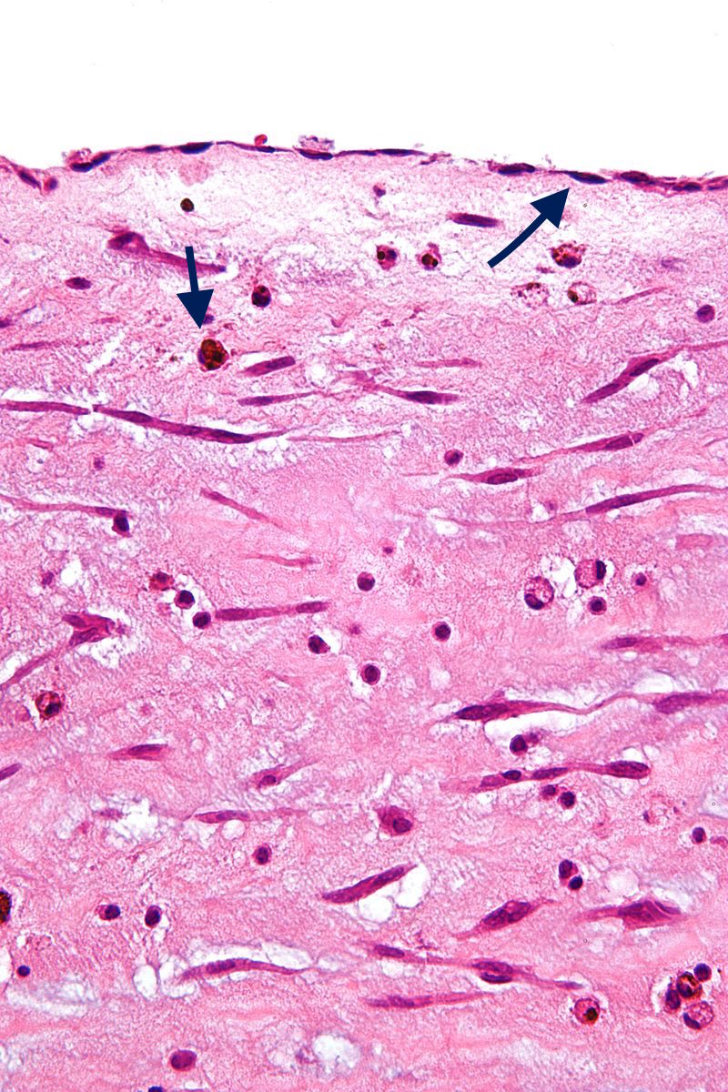 Black arrow (top): Endothelium Black arrow (bottom): Hemosiderin macrophage [19]