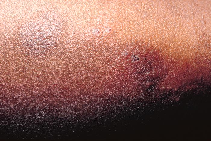 Vaccine recipient developed a secondary herpes infection adjacent to the vaccination site. From Public Health Image Library (PHIL). [24]