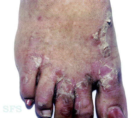 Epidermolysis bullosa simplex. Adapted from Dermatology Atlas.[6]