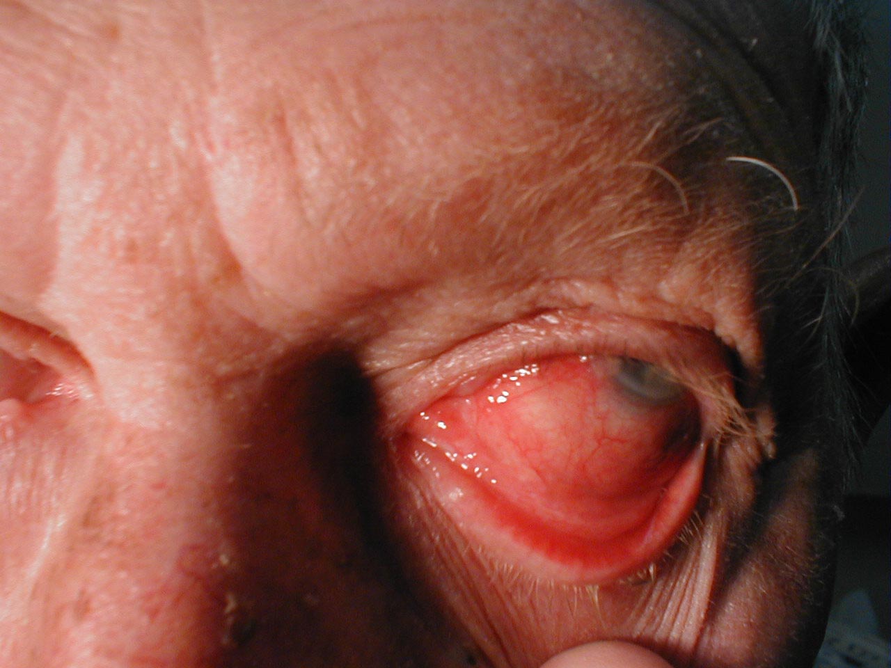 Conjunctivitis: Note inflamed conjunctiva of sclera and reflection onto underside of eyelid.