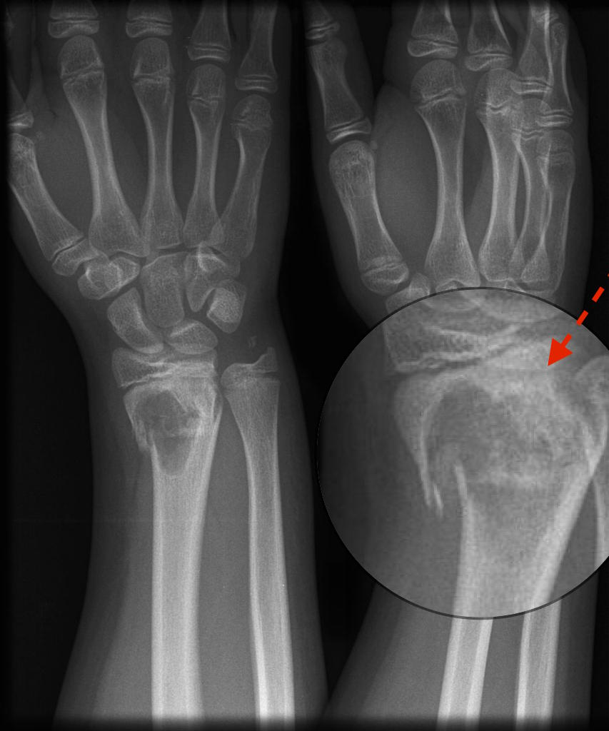 Pathological fracture: located in the metaphyseal region Adapted from Radiopedia