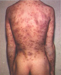 File:Syphilis lesions on back.jpg