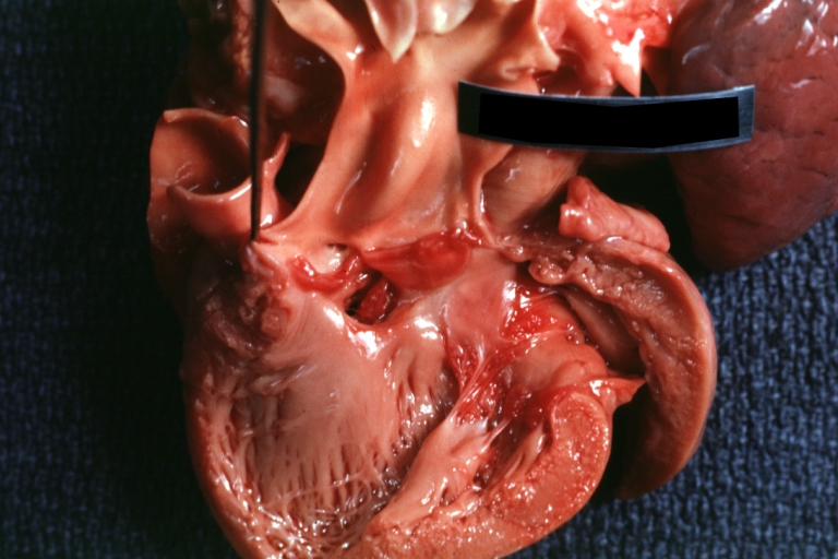 Ventricular Septal Defect (Perimembranous): Gross, natural color, (quite good photo - lesion before the operation)