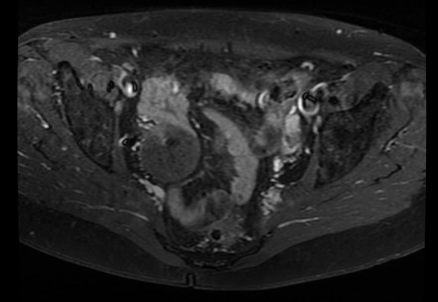 File:Ovarian fibroma MRI 007.jpg
