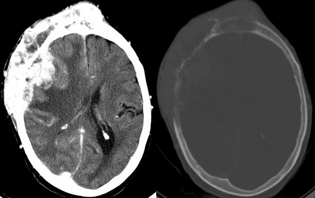 File:CT Brain metastasis.jpg
